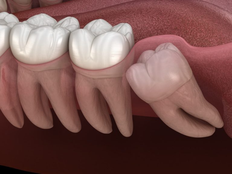 A Hole in My Gum Near Wisdom Tooth! Causes, Symptoms, and Remedies