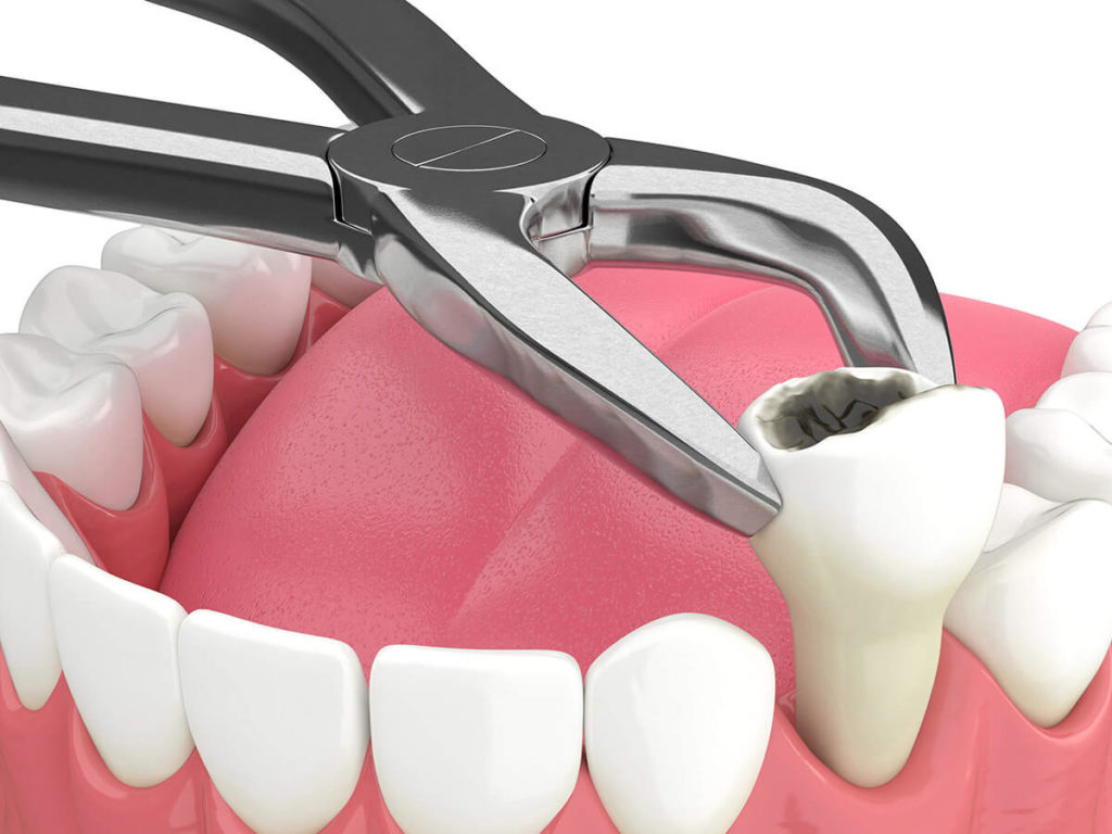 Causes of Bad Taste After Tooth Extraction