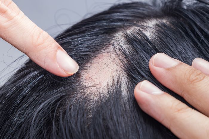 How to Combat Alopecia Areata And What Are Possible Treatments