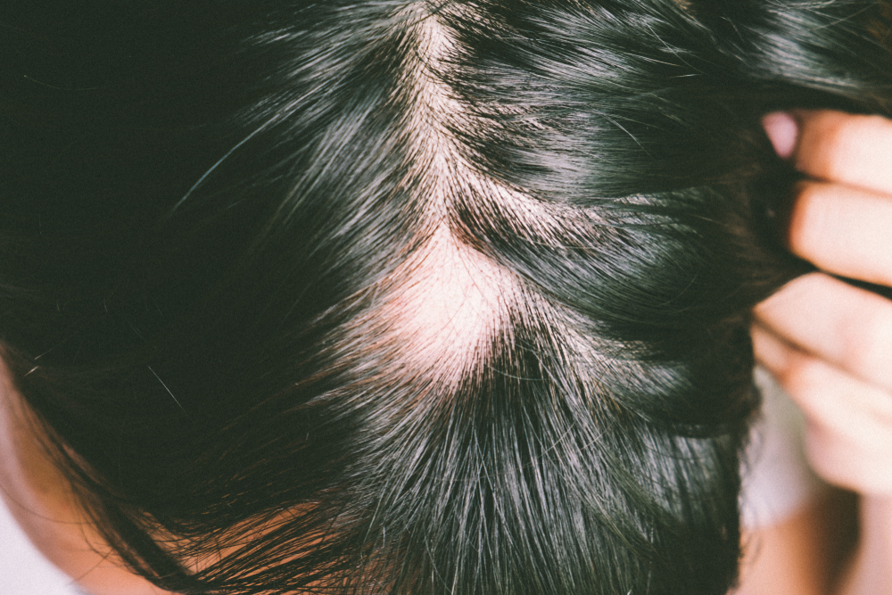 Alopecia Areata Causes