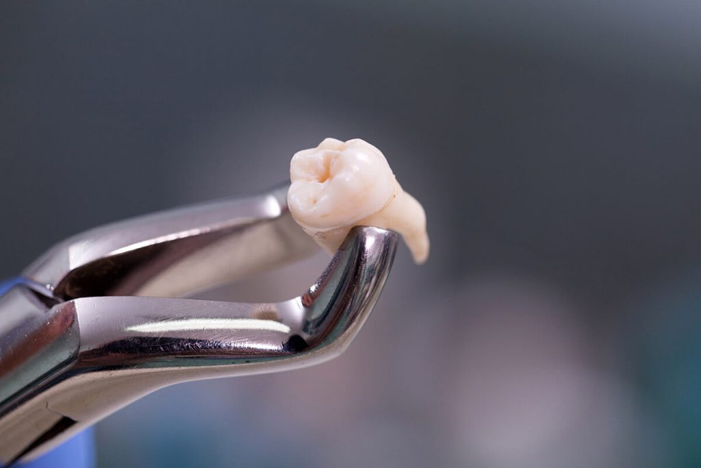 Which Is More Painful Tooth Extraction Or Filling? - 360Mag