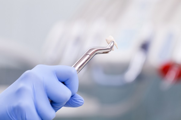 Understanding Tooth Extractions