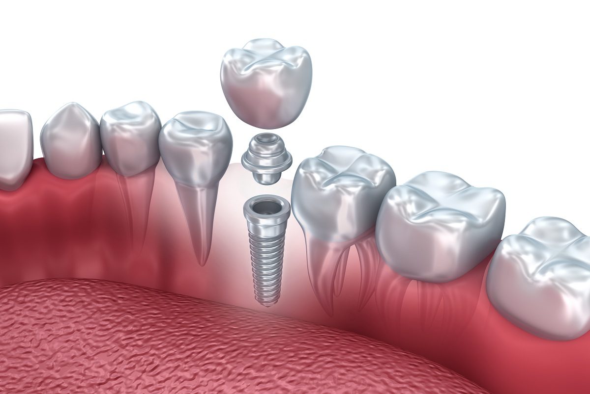 The Imperative of Rigorous Cleaning in Dental Implants Practices