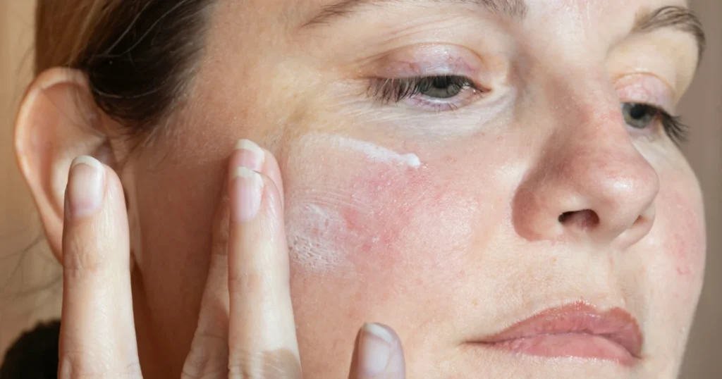 Holistic Skincare Routines for Rosacea-Prone Skin