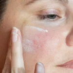 Holistic Skincare Routines for Rosacea-Prone Skin